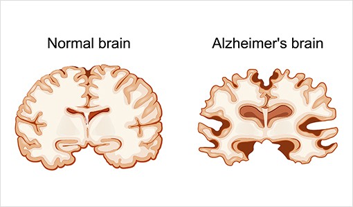 Power-Stem Biomedical Research_Chronic Neurological Diseases1